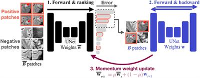 Online hard example mining vs. fixed oversampling strategy for segmentation of new multiple sclerosis lesions from longitudinal FLAIR MRI